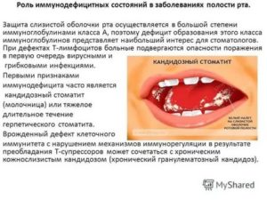 Подозрение на гонорею ротовой полости