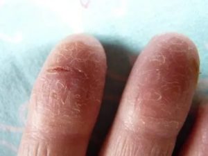 Лопается и облазит кожа на пальцах