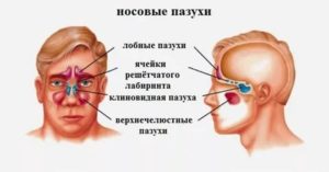 Мелкая киста клеток решетчатого лабиринта. Как лечится?