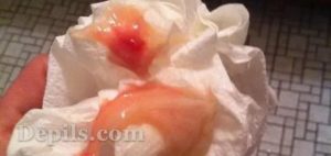 Кровянистые выделения после спринцевании. Такое бывает?