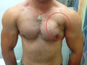 Частичное повреждение большой грудной мышцы
