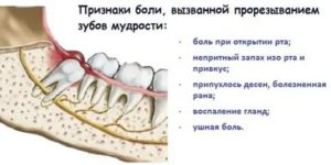 Боль от зуба мудрости или нет?