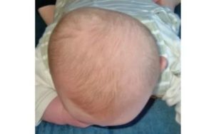 Несимметричный череп у ребенка