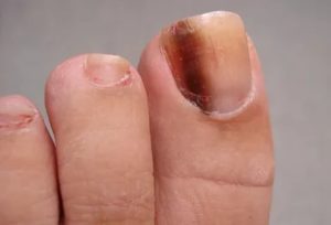 Коричневое пятно возле ногтя на ноге
