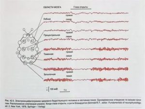 Что означает изменение корковой ритмики в результатах ЭЭГ