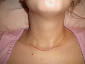 Воспаление лимфоузлов после удаления щитовидной железы