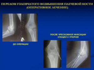 Закрытый перелом головчатого возвышения правой плечевой кисти со смещением