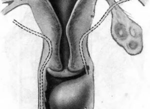 Киста влагалища