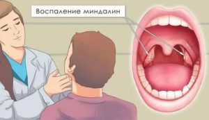 Рак или тонзиллит?