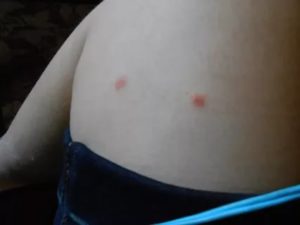 Красные пятна после укуса комаров