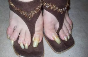 Ужасные ногти на ногах