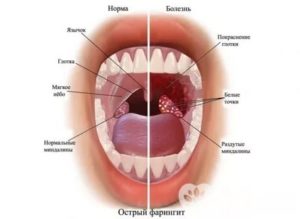 Красное горло, рефлюкс