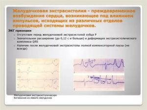 Желудочковая экстрасистолия, низкий пульс