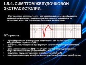 Желудочковая экстрасистолия, низкий пульс