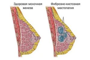 Фиброаденома, ФКМ, выделения из груди