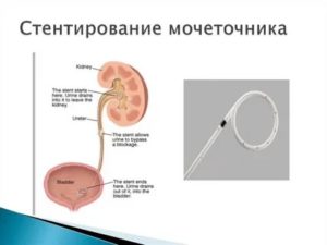 Выбор стента для мочеточника