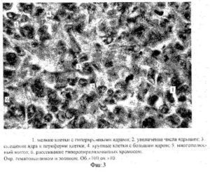 Единичные клетки с крупными ядрами