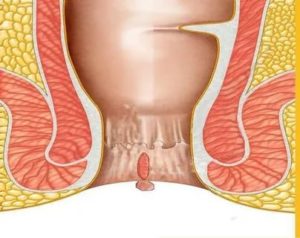 Молочница и геморрой