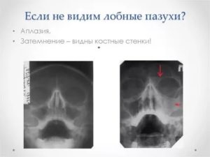 НЕдоразвитие правой лобной пазухи