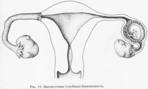 Как быстро забеременеть после внематочной беременности