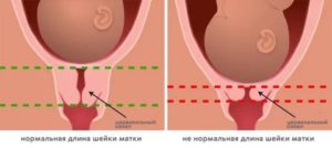 Короткая шейка матки в 16 недель