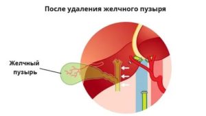 ГЭРБ после удаления желчного пузыря