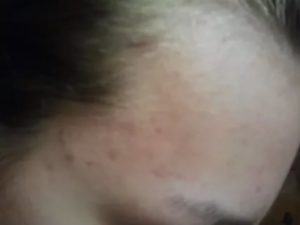 Странная сыпь на щеках и предплечьях ребенка, дерматолог не помог