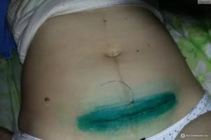 Киста на рубце после кесарева сечения