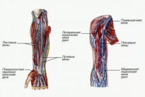 Венозный тромбоз плечевой вены