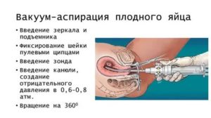 Вакуумный аборт после замершей беременности