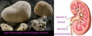 В правой почке камень 15 мм. Что делать?