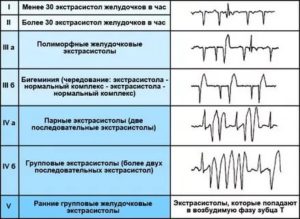 Желудочковая экстрасистолия, низкий пульс