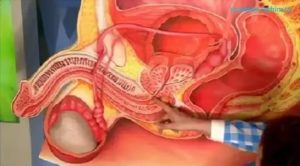 Простатит. Дискомфорт в члене