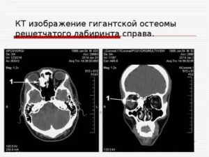 Почему на рентгене не прослеживается решетчатый лабиринт?