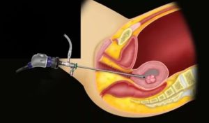 Гистерорезектоскопия полипа эндометрия