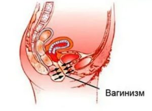 Как проходить гинеколога при вагинизме?