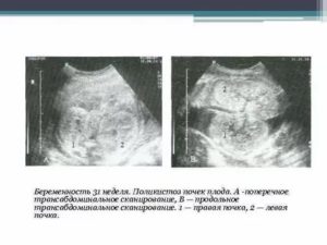 Поликистоз почек и беременность