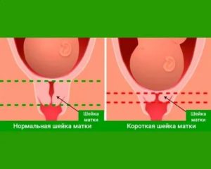 Короткая шейка матки в 16 недель