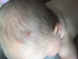 Болячки на голове у ребенка уже год
