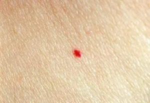 Мелкие красные точки на коже