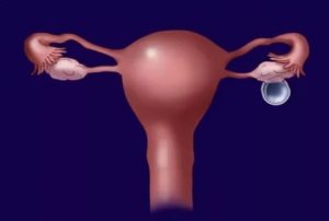 Киста яичника и полип