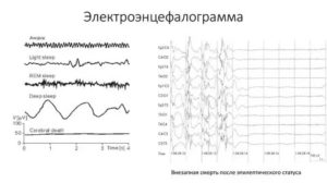 Расшифровать результаты ЭЭГ, РЭГ