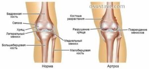 Боль в колене после удаления мениска