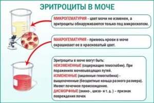 Эритроциты в моче при беременности