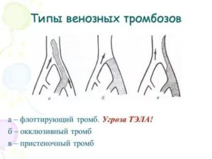 Признаки окклюзивного тромбоза лучевой артерии