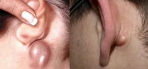 Болячка около уха
