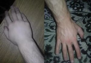 Вздулась вена на запястье