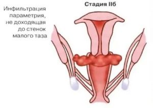 Инфильтрат в малом тазу