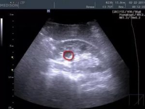 Затемнение в почке