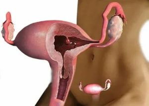 Болит грудь после удаления полипа эндометрия